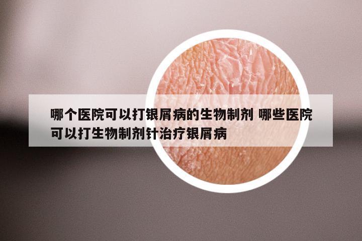 哪个医院可以打银屑病的生物制剂 哪些医院可以打生物制剂针治疗银屑病