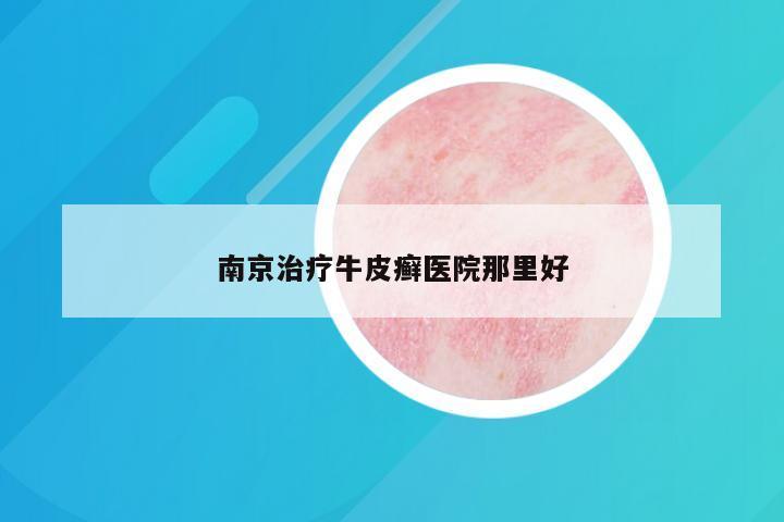 南京治疗牛皮癣医院那里好