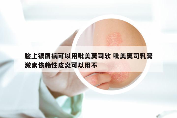 脸上银屑病可以用吡美莫司软 吡美莫司乳膏激素依赖性皮炎可以用不