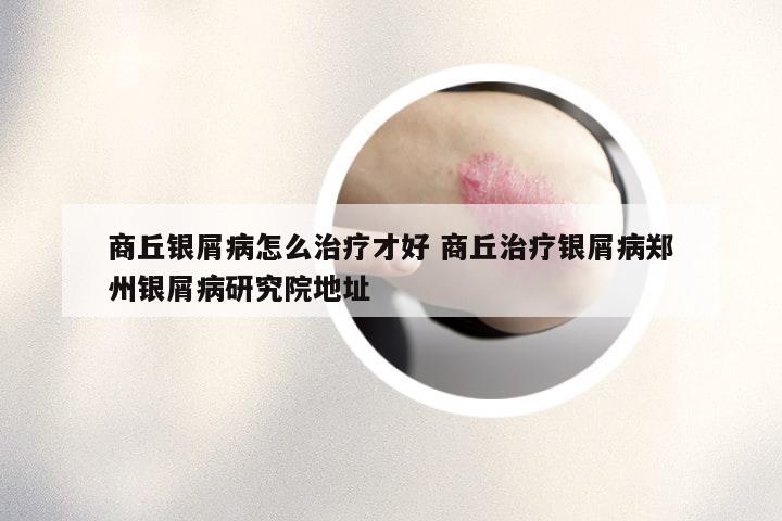 商丘银屑病怎么治疗才好 商丘治疗银屑病郑州银屑病研究院地址