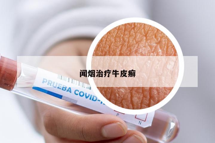 闻烟治疗牛皮癣