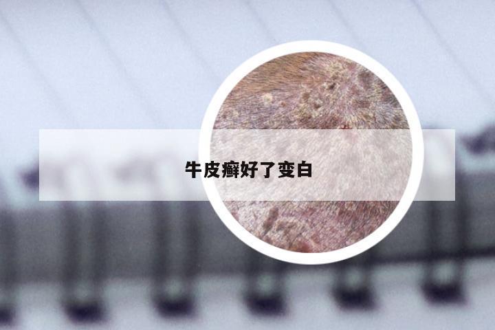 牛皮癣好了变白