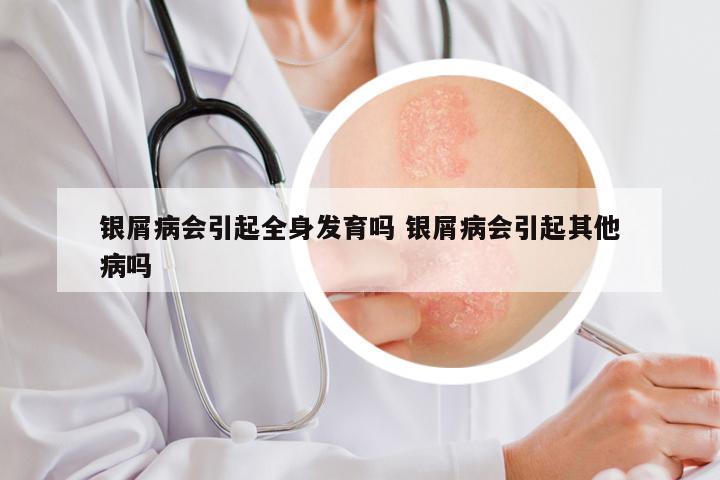 银屑病会引起全身发育吗 银屑病会引起其他病吗