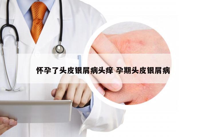 怀孕了头皮银屑病头痒 孕期头皮银屑病