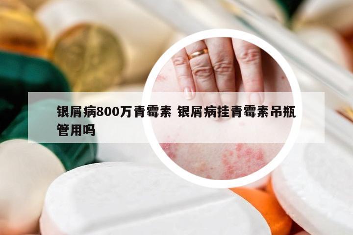 银屑病800万青霉素 银屑病挂青霉素吊瓶管用吗