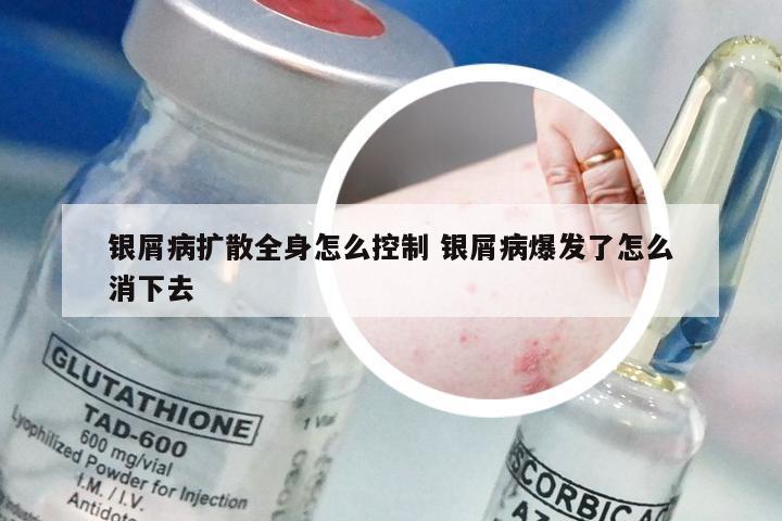 银屑病扩散全身怎么控制 银屑病爆发了怎么消下去