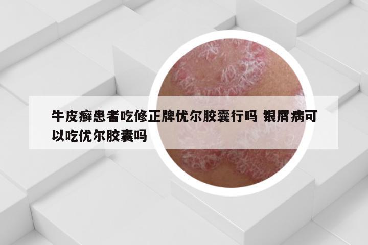 牛皮癣患者吃修正牌优尔胶囊行吗 银屑病可以吃优尔胶囊吗