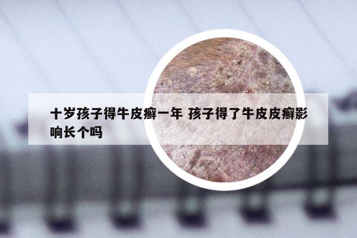 十岁孩子得牛皮癣一年 孩子得了牛皮皮癣影响长个吗