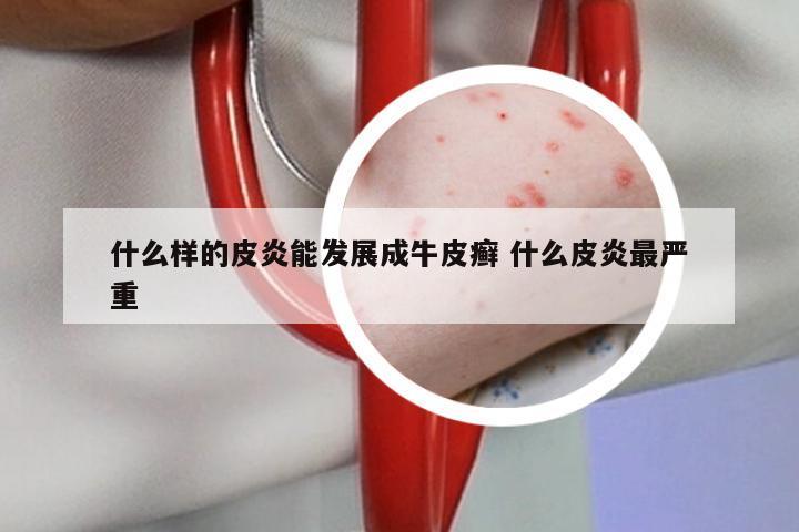 什么样的皮炎能发展成牛皮癣 什么皮炎最严重
