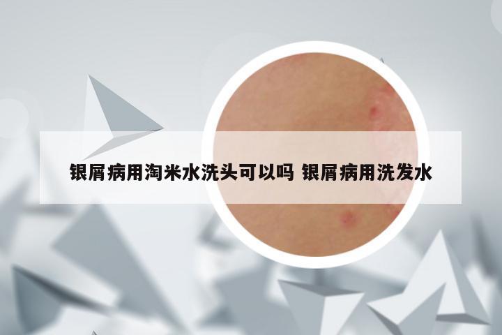 银屑病用淘米水洗头可以吗 银屑病用洗发水