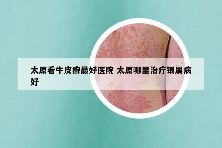 太原看牛皮癣最好医院 太原哪里治疗银屑病好