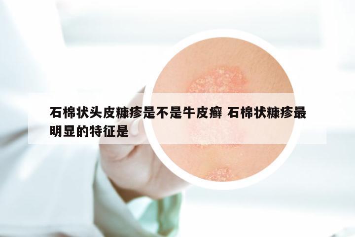 石棉状头皮糠疹是不是牛皮癣 石棉状糠疹最明显的特征是