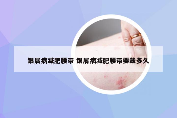 银屑病减肥腰带 银屑病减肥腰带要戴多久