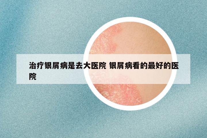 治疗银屑病是去大医院 银屑病看的最好的医院