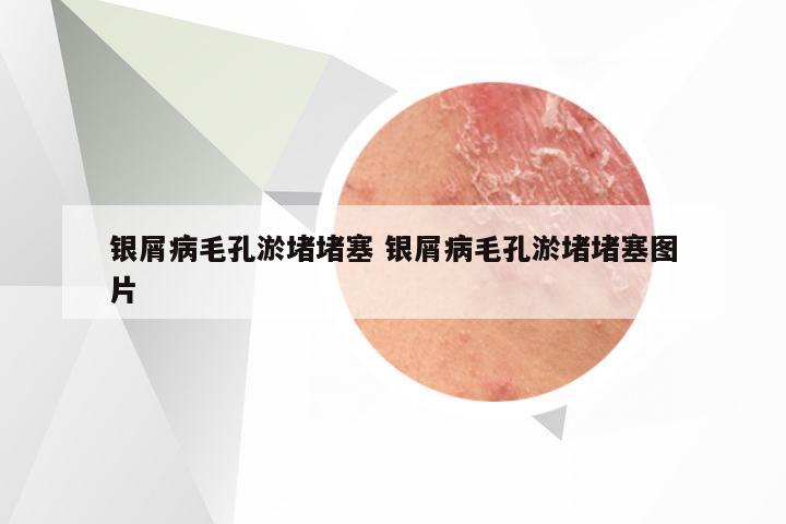 银屑病毛孔淤堵堵塞 银屑病毛孔淤堵堵塞图片