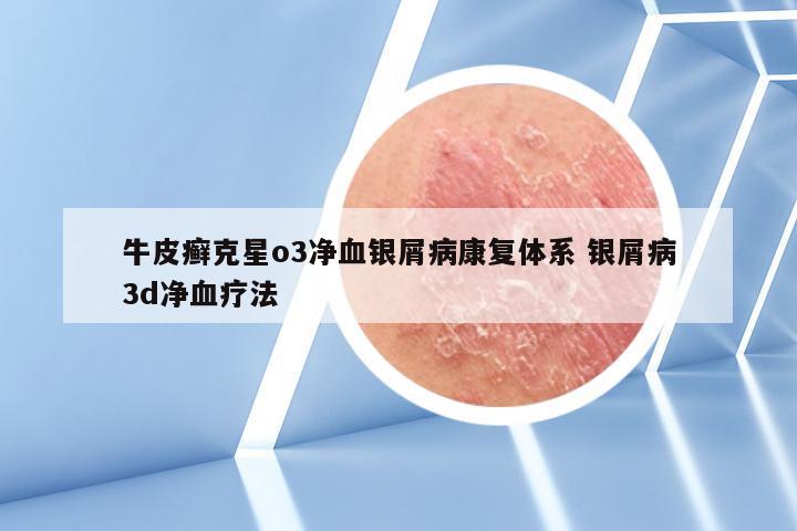 牛皮癣克星o3净血银屑病康复体系 银屑病3d净血疗法
