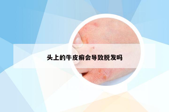 头上的牛皮癣会导致脱发吗