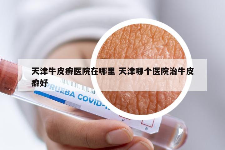 天津牛皮癣医院在哪里 天津哪个医院治牛皮癖好