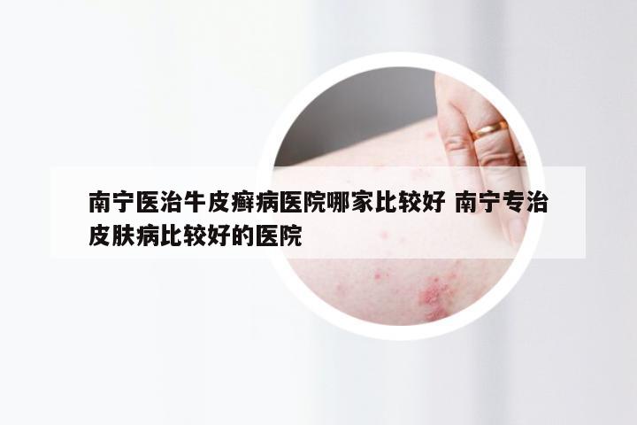 南宁医治牛皮癣病医院哪家比较好 南宁专治皮肤病比较好的医院