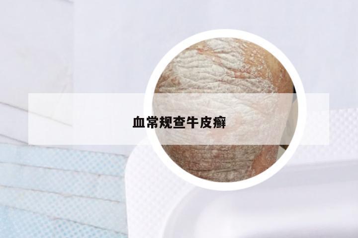 血常规查牛皮癣