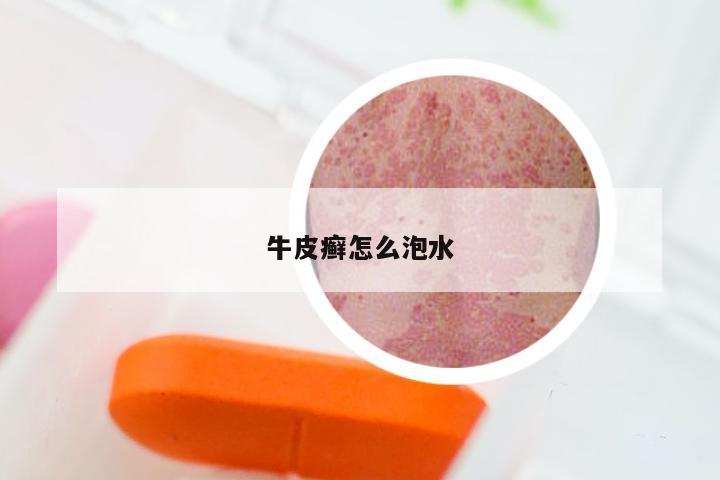 牛皮癣怎么泡水
