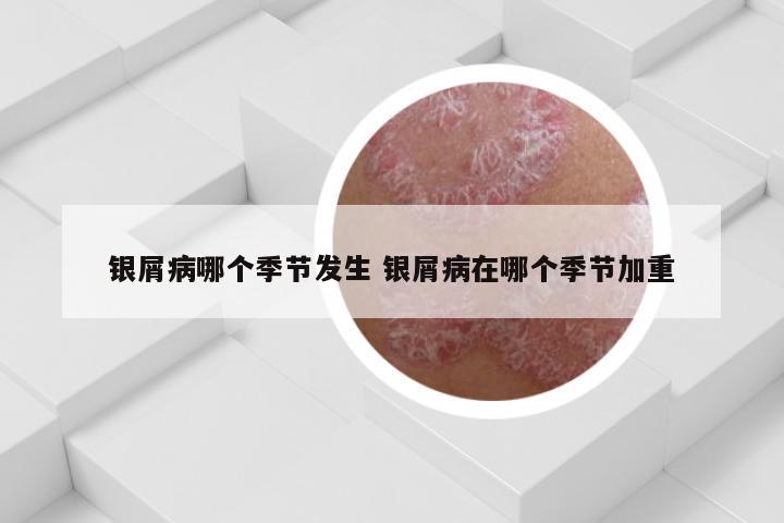 银屑病哪个季节发生 银屑病在哪个季节加重