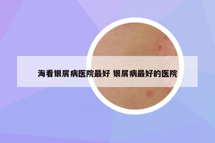 海看银屑病医院最好 银屑病最好的医院