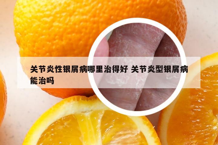 关节炎性银屑病哪里治得好 关节炎型银屑病能治吗