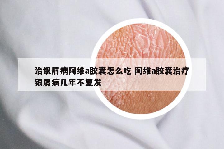 治银屑病阿维a胶囊怎么吃 阿维a胶囊治疗银屑病几年不复发