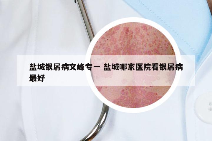 盐城银屑病文峰专一 盐城哪家医院看银屑病最好