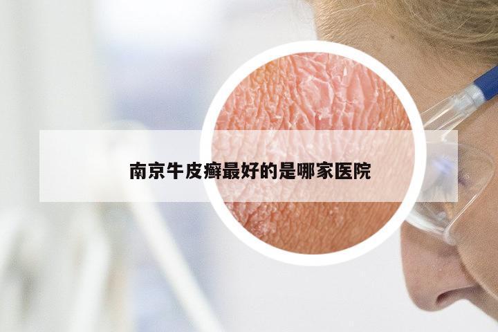 南京牛皮癣最好的是哪家医院