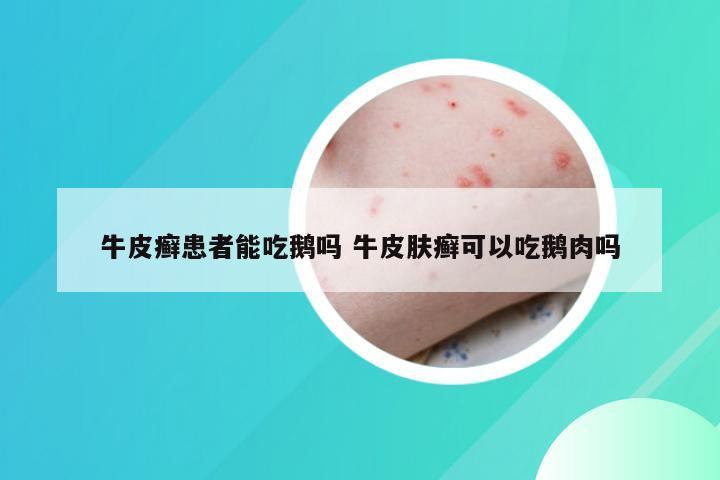 牛皮癣患者能吃鹅吗 牛皮肤癣可以吃鹅肉吗