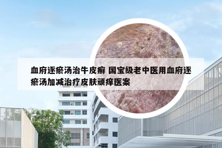 血府逐瘀汤治牛皮癣 国宝级老中医用血府逐瘀汤加减治疗皮肤顽痒医案