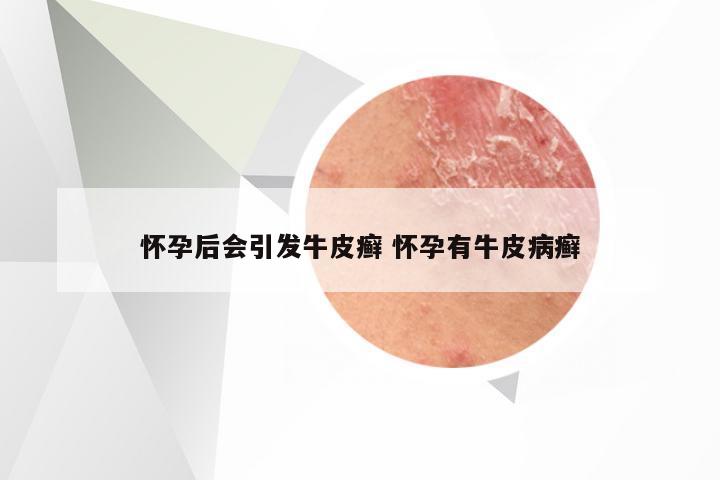 怀孕后会引发牛皮癣 怀孕有牛皮病癣