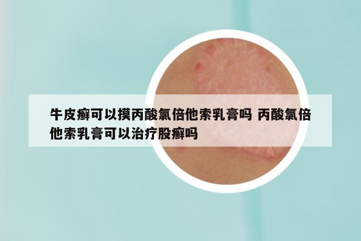 牛皮癣可以摸丙酸氯倍他索乳膏吗 丙酸氯倍他索乳膏可以治疗股癣吗