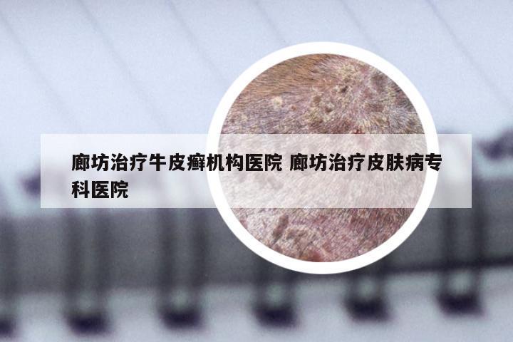 廊坊治疗牛皮癣机构医院 廊坊治疗皮肤病专科医院