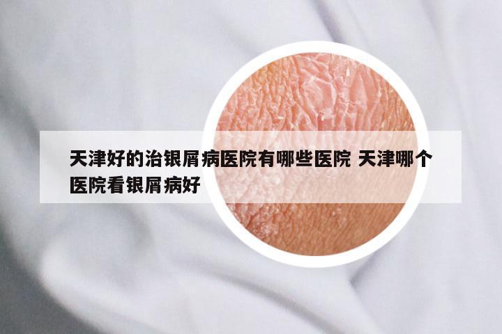 天津好的治银屑病医院有哪些医院 天津哪个医院看银屑病好