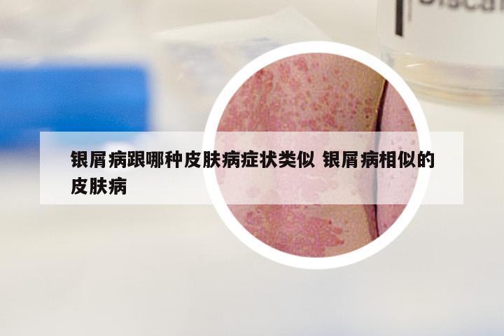 银屑病跟哪种皮肤病症状类似 银屑病相似的皮肤病