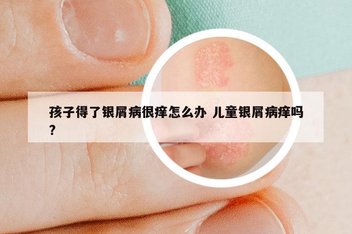 孩子得了银屑病很痒怎么办 儿童银屑病痒吗?