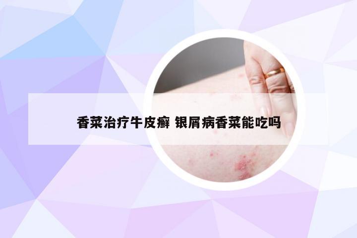 香菜治疗牛皮癣 银屑病香菜能吃吗