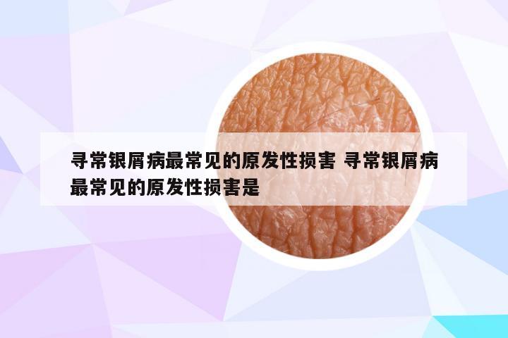 寻常银屑病最常见的原发性损害 寻常银屑病最常见的原发性损害是