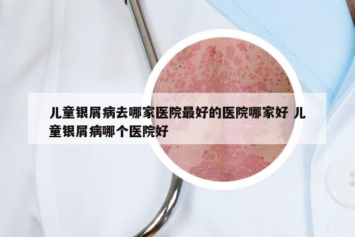 儿童银屑病去哪家医院最好的医院哪家好 儿童银屑病哪个医院好