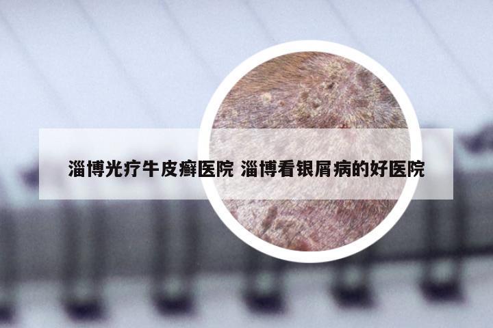 淄博光疗牛皮癣医院 淄博看银屑病的好医院