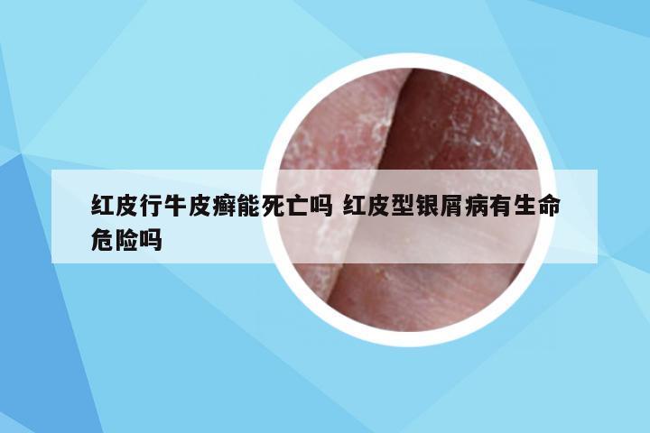 红皮行牛皮癣能死亡吗 红皮型银屑病有生命危险吗