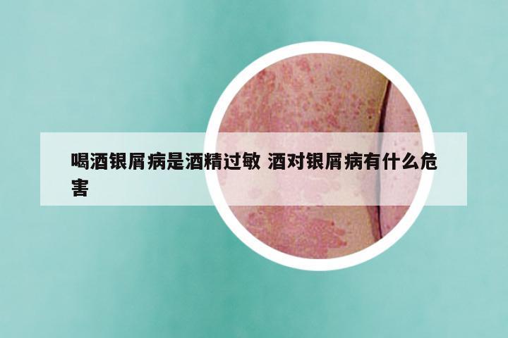 喝酒银屑病是酒精过敏 酒对银屑病有什么危害