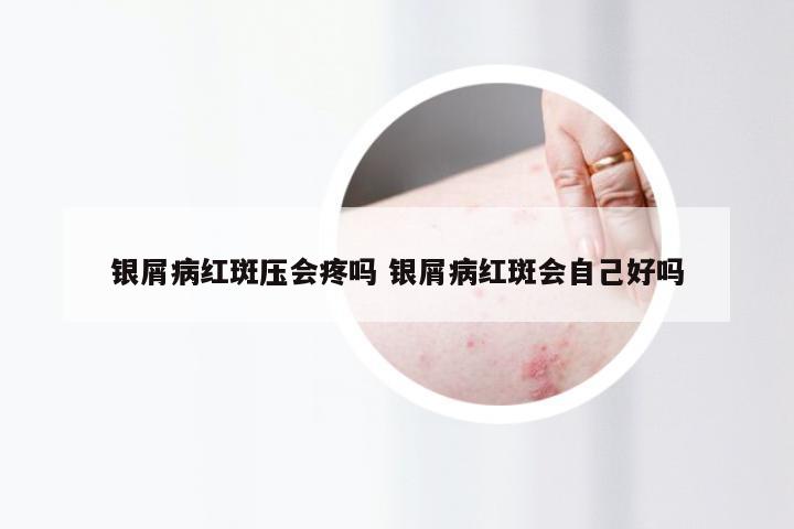银屑病红斑压会疼吗 银屑病红斑会自己好吗