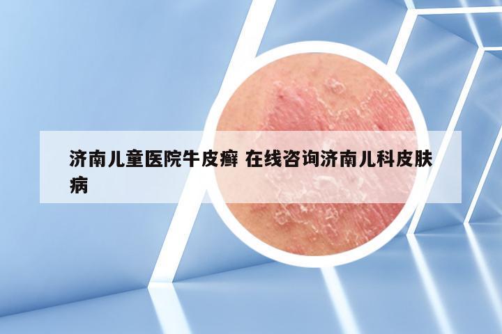 济南儿童医院牛皮癣 在线咨询济南儿科皮肤病