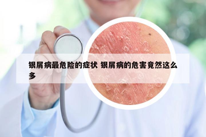 银屑病最危险的症状 银屑病的危害竟然这么多