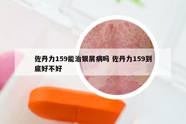 佐丹力159能治银屑病吗 佐丹力159到底好不好