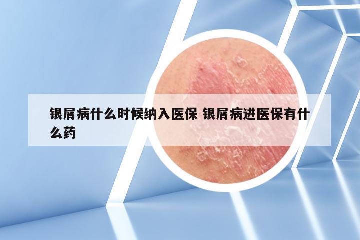 银屑病什么时候纳入医保 银屑病进医保有什么药